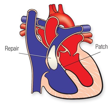 TOF Surgery Cost in India