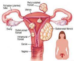 Myoma(Uterine Fibroids) Treatment in India 