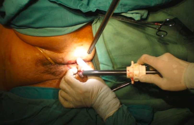 Minimally Invasive Gastrointestinal Surgery (MIGS)