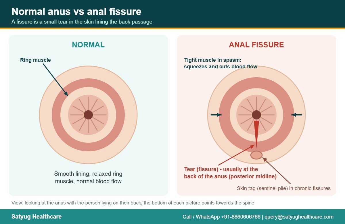 Anal Fissure: Causes, Symptoms, Treatment and Lateral Sphincterotomy Cost in India