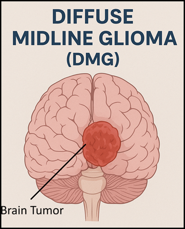 Diffuse Midline Glioma (DMG) Brain Tumor Surgery in India