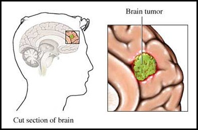 Astrocytoma causes and Treatment