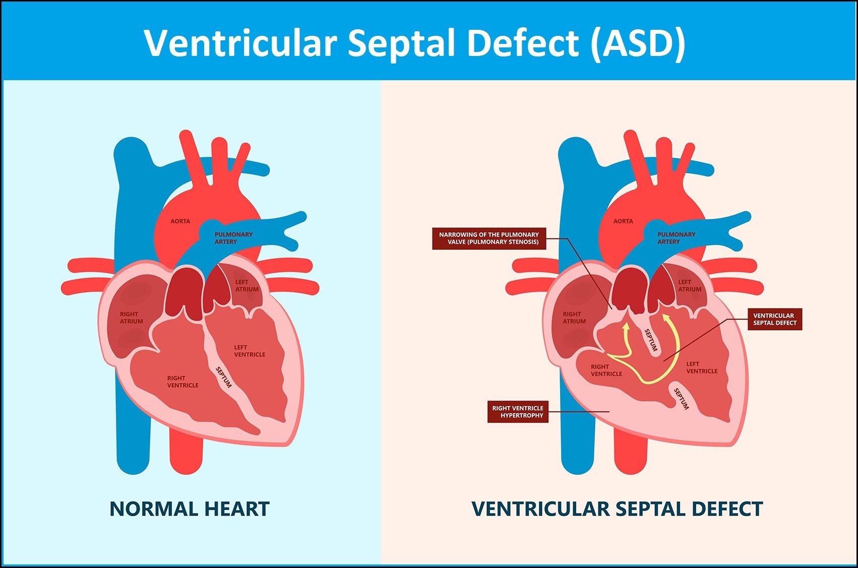 Atrial septal defects surgery 