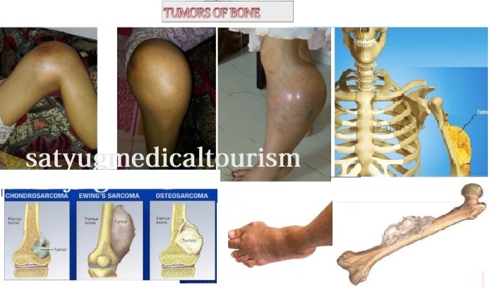 bone tumor treatment in delhi , bone tumor surgery in india