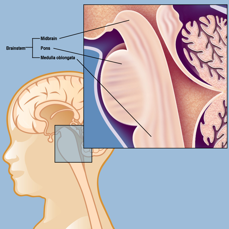 Brain Stem Tumor cost in India