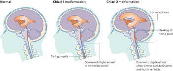 chairi malformtion treatment