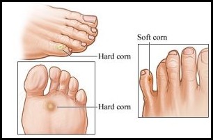 Calluses,Corn and Warts Treatment
