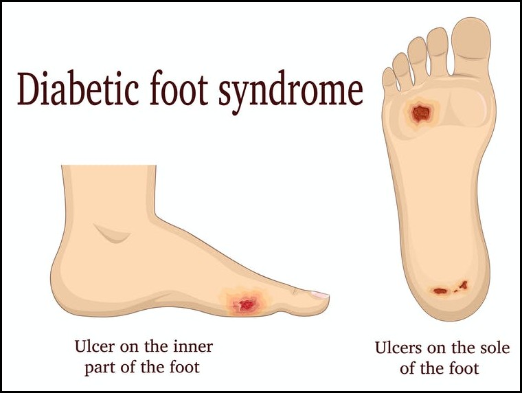 Diabetic Foot/Peripheral Aterial Disease/Sensory Neuropathy affecting Symptoms and Treatment