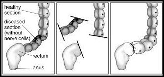 Hirschsprung’s disease Symptoms