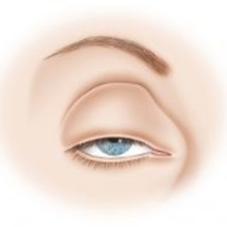 Ocuplasty Surgery cost in India