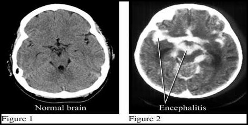 Encephalitis causes and Treatment
