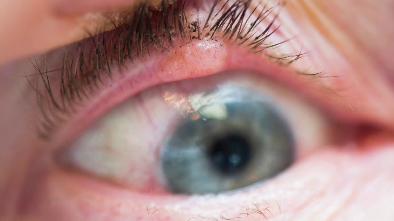 Ocuplasty Surgery cost in India