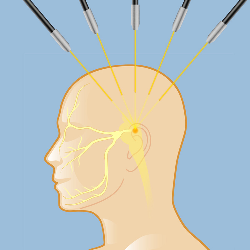 gamma Knife procedure