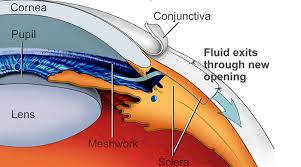 Glaucoma Treatment cost in India
