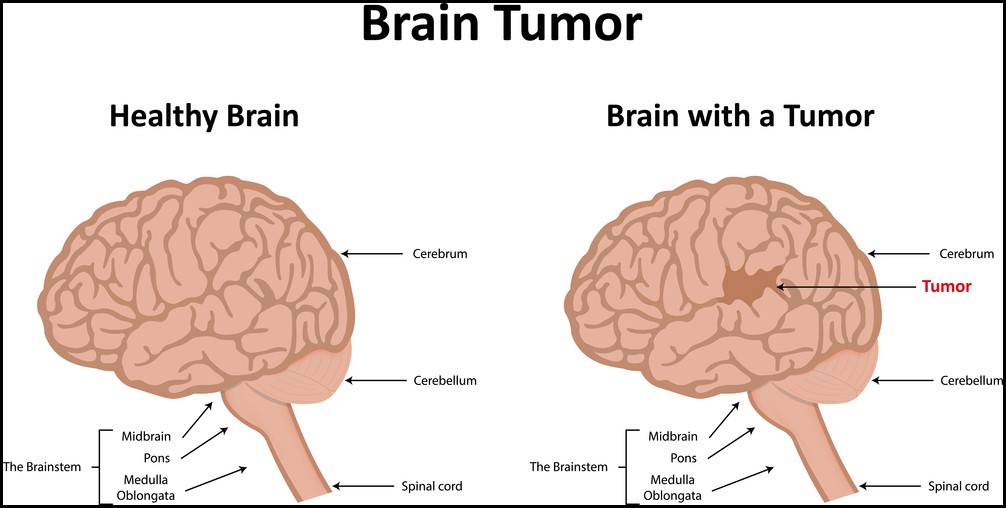 Glioblastoma causes,symptoms and Treatment