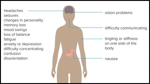 Glioblastoma causes,symptoms and Treatment