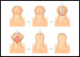 Hypospadias Repair cost in India