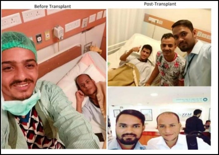 Kidney Transplant Cost in Delhi