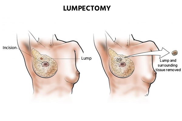 Lumpectomy surgery cost in India |  Breast Cancer surgery cost in Delhi  | Robotic Breast Lumpectomy Surgery cost in India | 