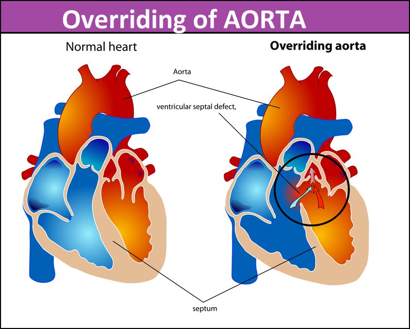 overriding of aorta treatment in delhi 