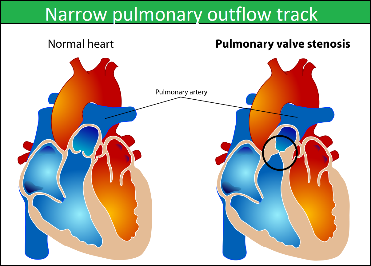 pulmonary stenosis  
