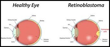Retinoblastoma Causes and Treatment