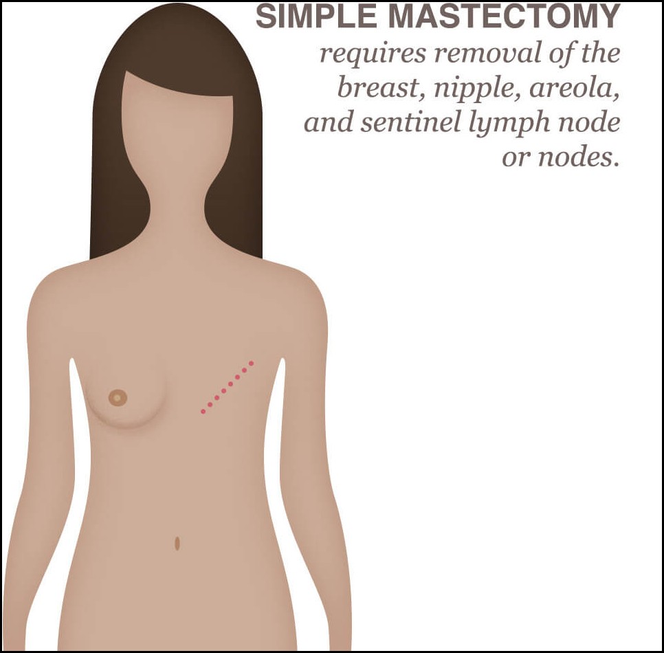 MASTECTOMY - MODIFIED RADICAL / RADICAL cost in India