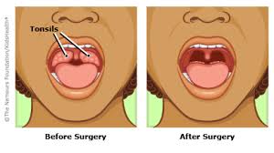 Tonsillectomy or Tonsillitis cost in India