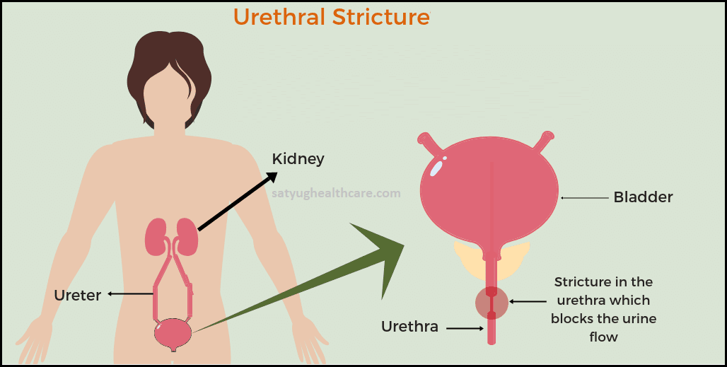 Urethral Stricture Treatment Hospital & Surgery Specialist in India