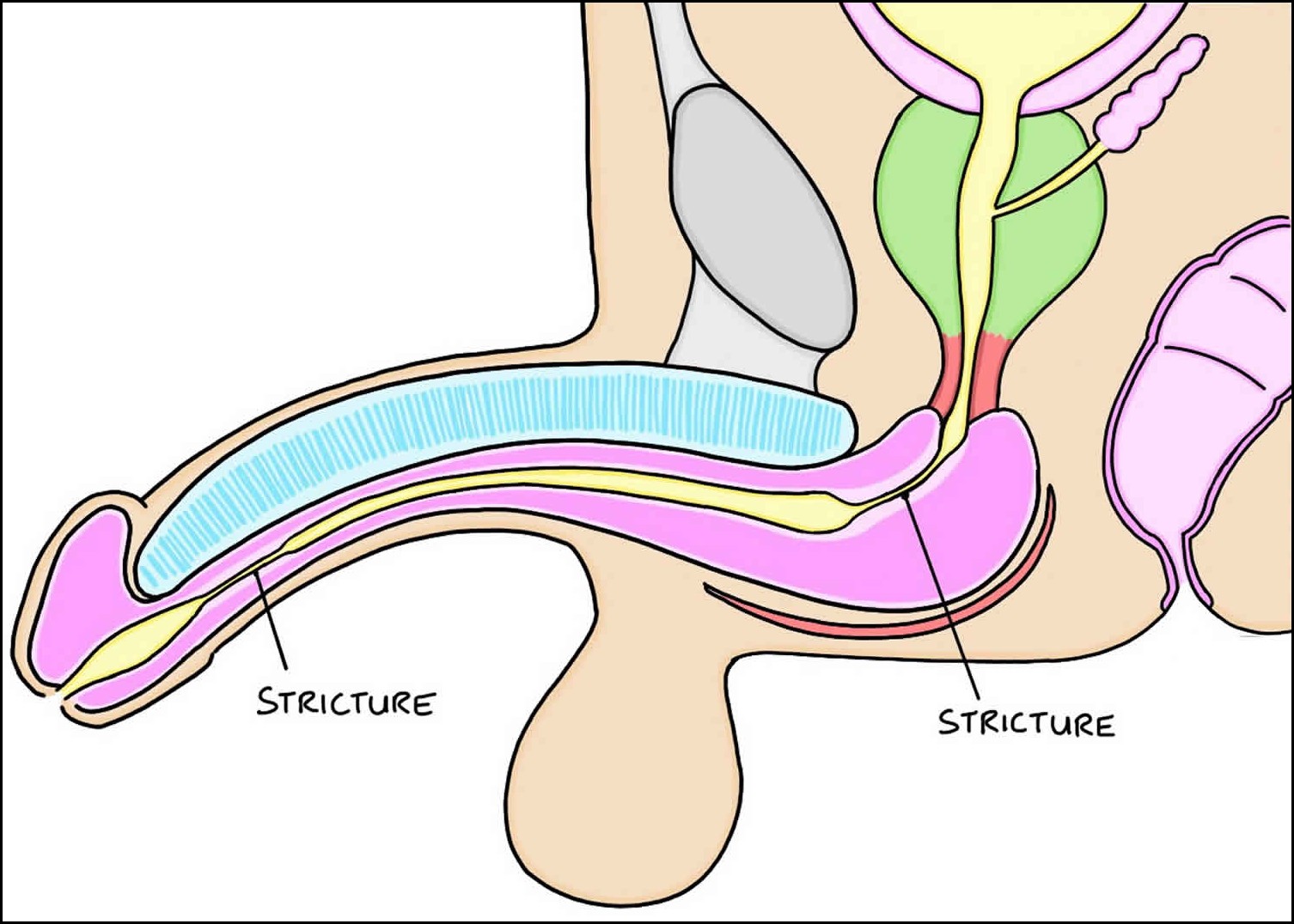 Urethroplasty is a surgery to treat Urethral Stricture