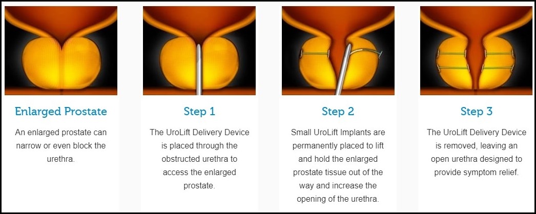 UroLift Procedure step by step details 