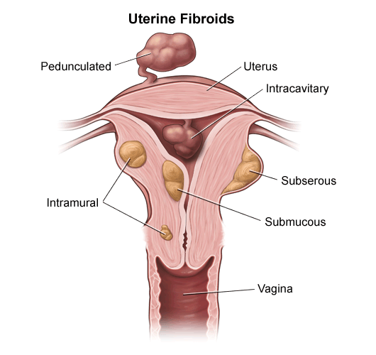 uterine fibroids removal surgery cost in india