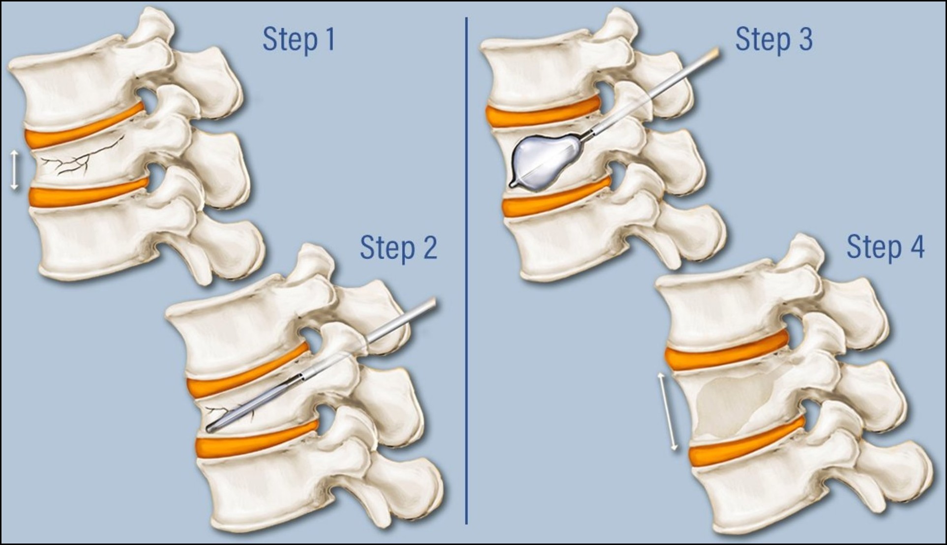 Step by step explaint Vertebroplasty surgery in India