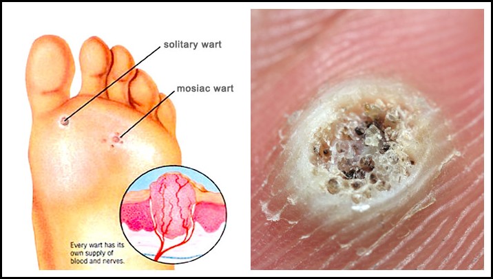 Seed Corn On Foot Plantar Warts: Causes, Symptoms And Treatment