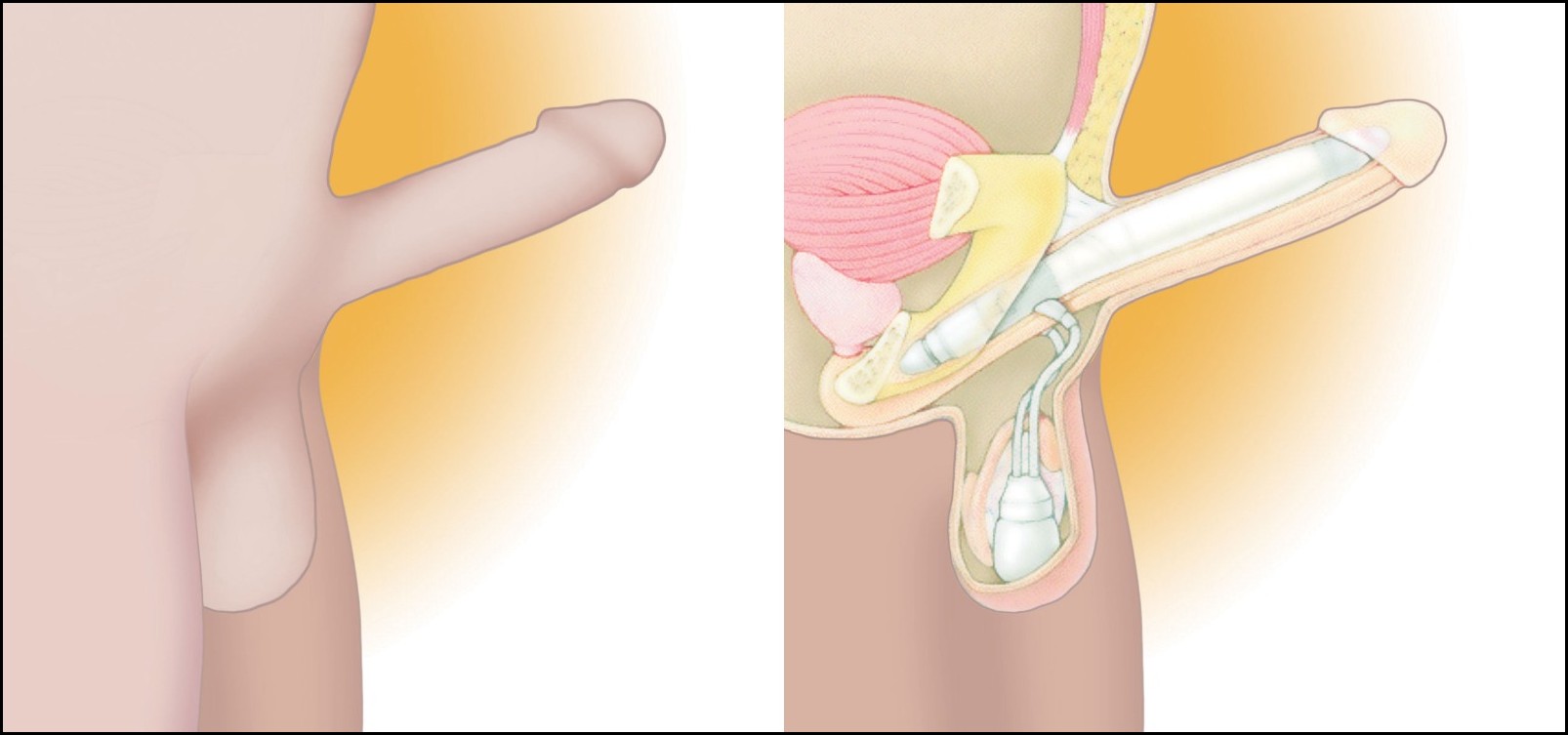 Penile implant surgery in india
