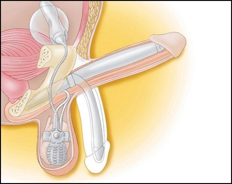 Penile Prosthesis implantation Surgery Cost in India