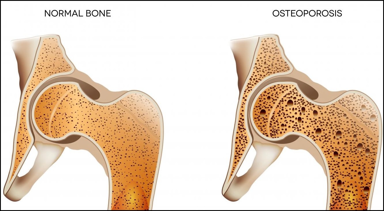 Osteoporosis treatment in india