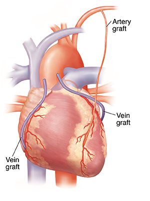 Coronary Artery Bypass Grafting cost in India