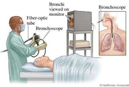 Bronchoscopy treatment cost in Delhi| Bronchoscopy treatment cost in India| Delhi| Mumbai| Gurgaon| Satyughealthcare.com