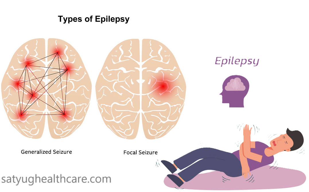 Epilepsy Surgery Cost In India | International Patients in Delhi