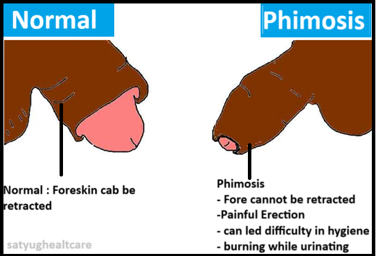 phimosis circumcision surgery cost in india 