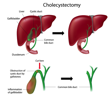 laparoscopic cholecystectomy surgery cost in india