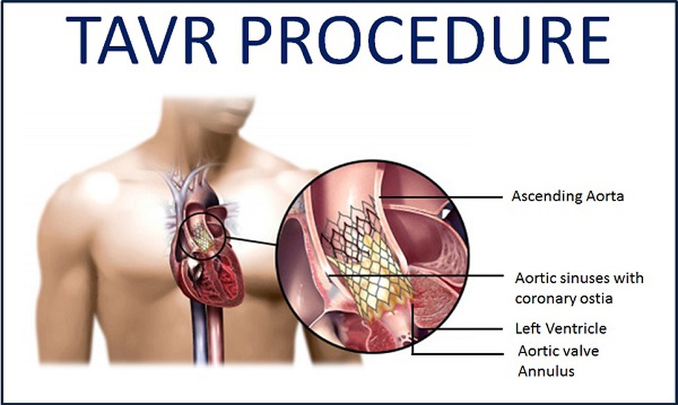 Transcatheter aortic valve replacement (TAVR) Procedure cost in Delhi|Transcatheter aortic valve replacement (TAVR) Procedure cost in India| Delhi| Mumbai| Gurgaon| Satyughealthcare.com
