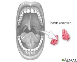 Tonsillectomy or Tonsillitis treatment cost in Delhi| Tonsillectomy or Tonsillitis treatment cost in India| Delhi| Mumbai| Gurgaon| Satyughealthcare.com