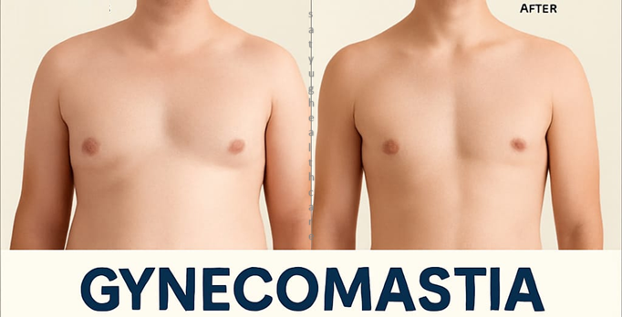 Gynecomastia surgery cost in India