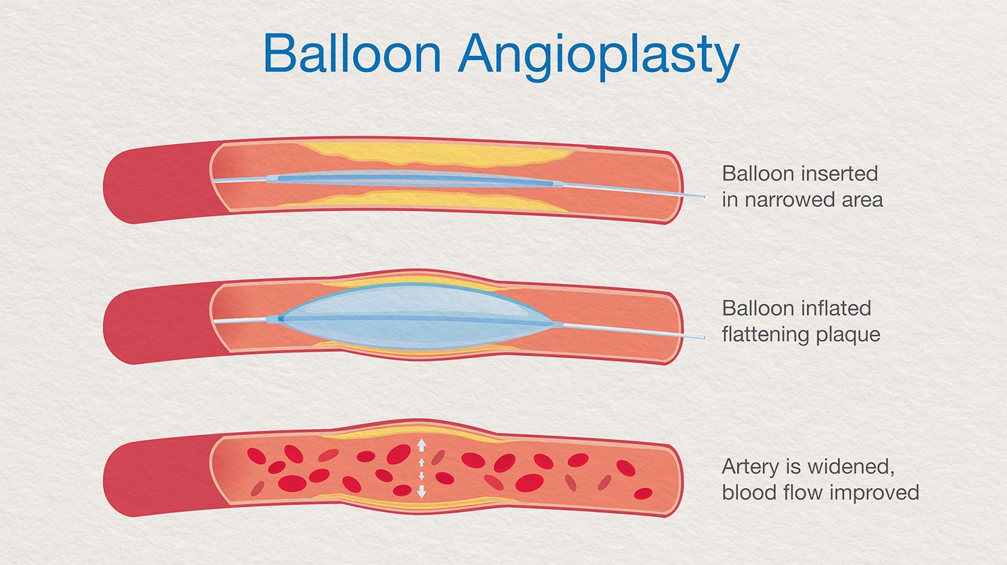 Peripheral Angioplasty with Balloon Cost Surgery in India