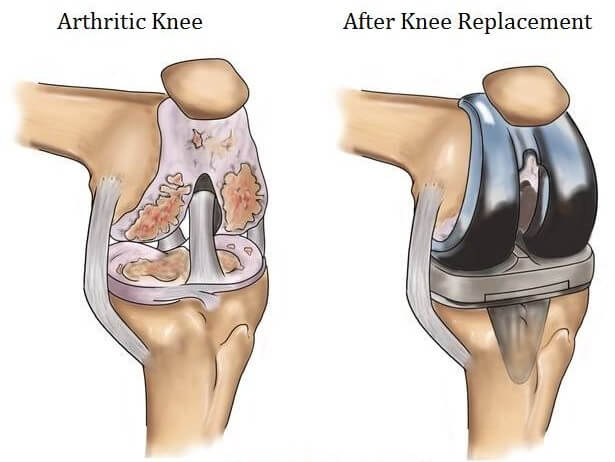 Bilateral/Both knee replacement cost in India, Best Bilateral/Both knee replacement hospital in Delhi,India,Satyughealthcare.com