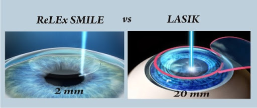 ReLex SMILE eye treatment cost in Delhi| ReLex SMILE eye treatment cost in India| Delhi| Mumbai| Gurgaon| Satyughealthcare.com