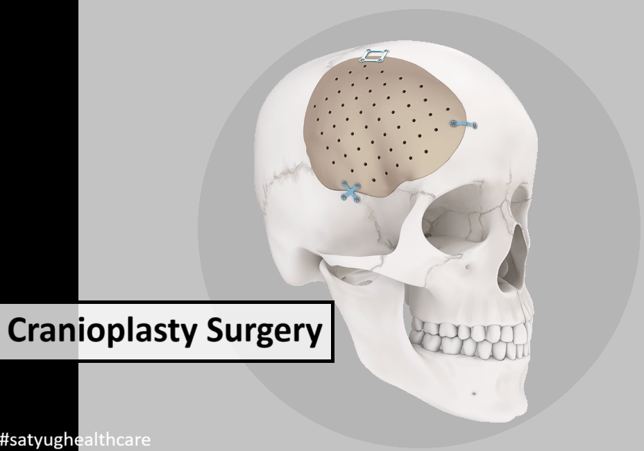 cranioplasty surgery cost in india
