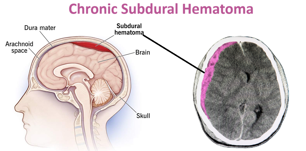 chronic subdural hematoma Embolization Coil procedure Cost in India